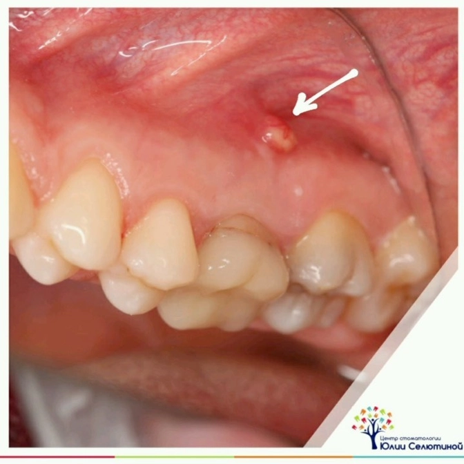 Что делать с зубом, если появился свищ? 
