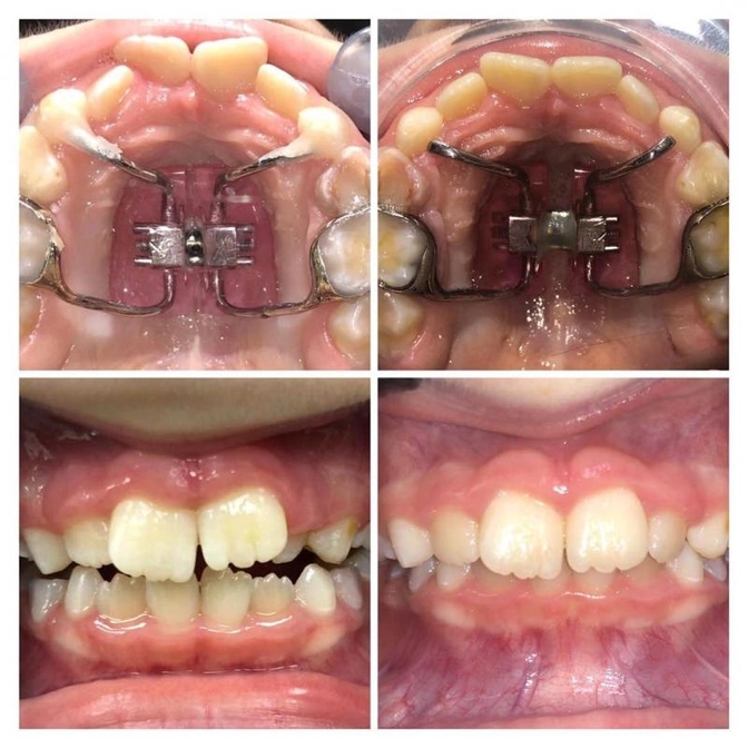 Использование аппарата Haas: показания и результаты.