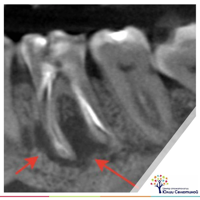 "Киста" зуба: Лечение.