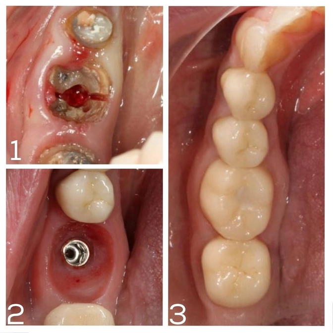 Клинический случай: замена мостовидного протеза. 