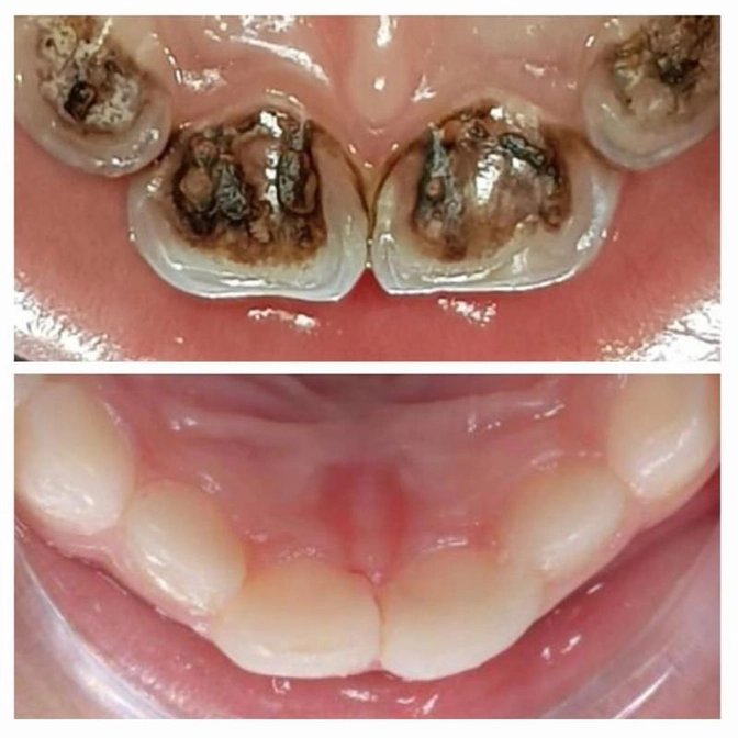 Почему я не люблю серебрение молочных зубов.