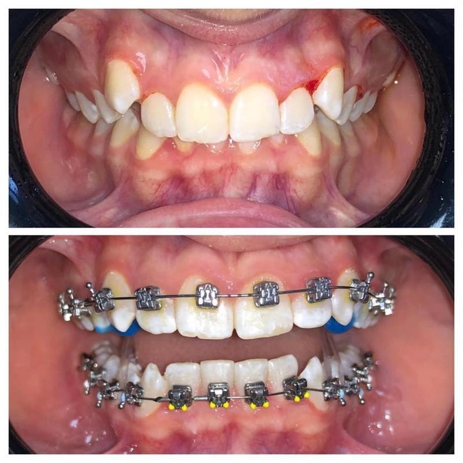 Чем чревата преждевременная потеря молочных зубов?