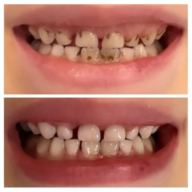 Профессиональная гигиена у ребёнка