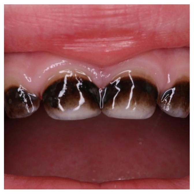 Серебрение молочных зубов 