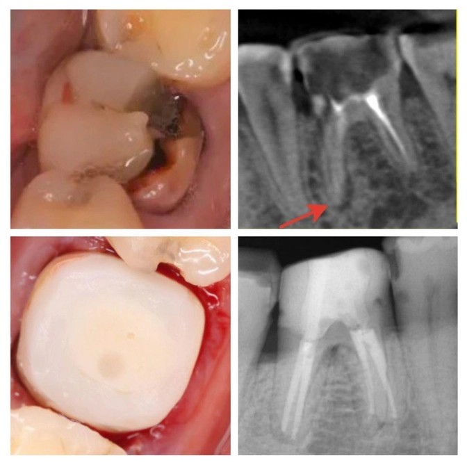 "Красный русский" или́ формалиновые зубы 