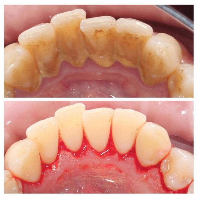 Профессиональная гигиена.