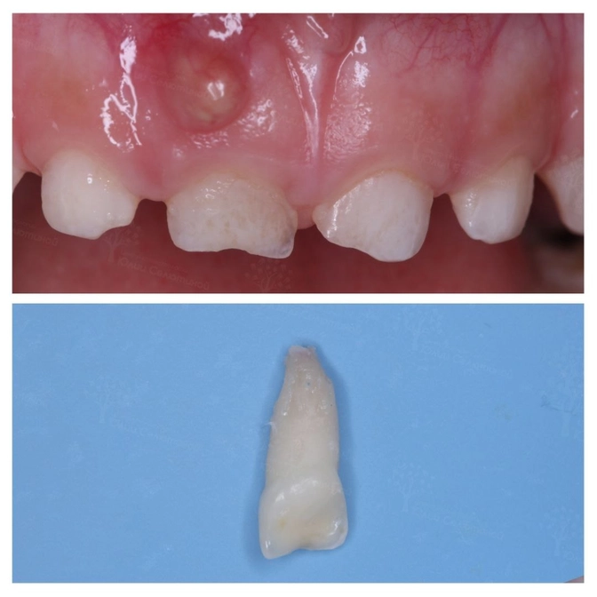 Обнаружили сверхкомплектный зуб: что делать?