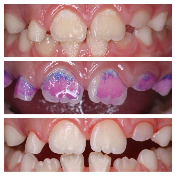 Как проверить, насколько хорошо мы чистим зубы? 