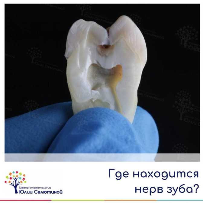 Где находится "нерв" зуба? 