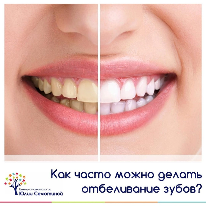 Как часто можно делать отбеливание? 