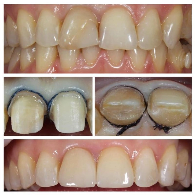 Виниры: этапы лечения.