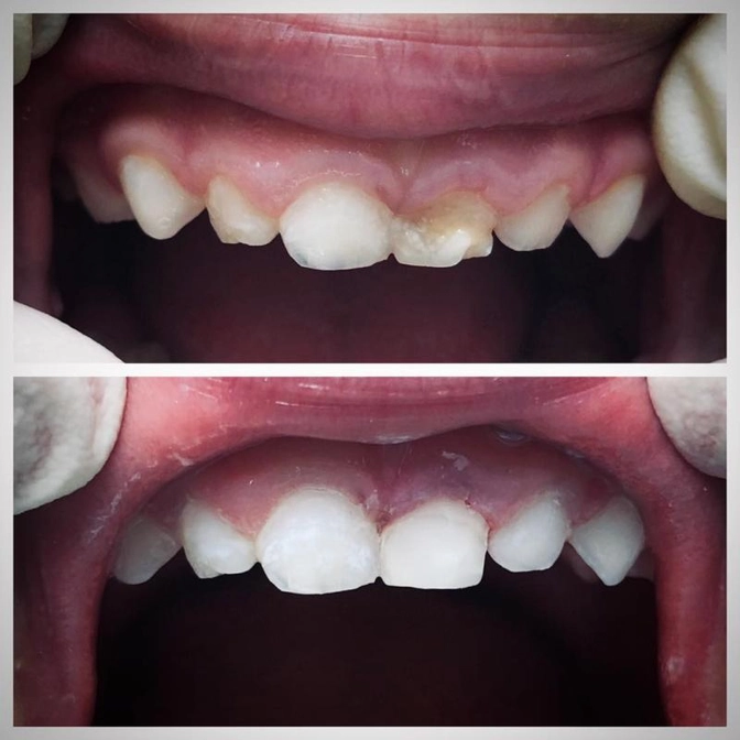 Постановка пломб на центральные зубы.