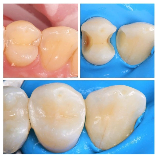 Кариес на контакте зубов 