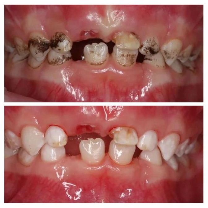 Зачем счищать налет Пристли? 