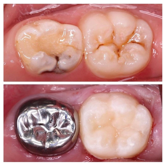 Как выглядят коронки на молочных зубах?