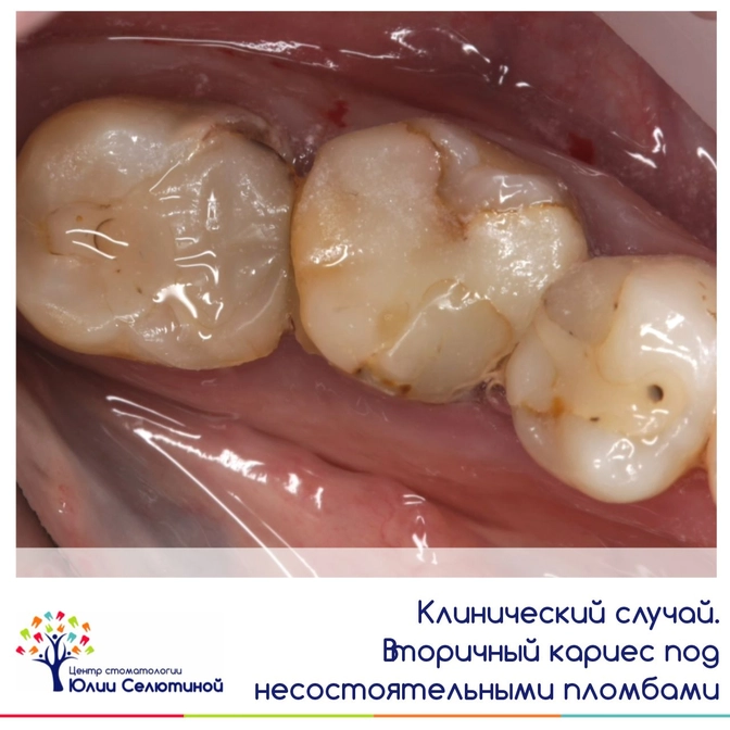 Вторичный кариес и несостоятельгые пломбы 