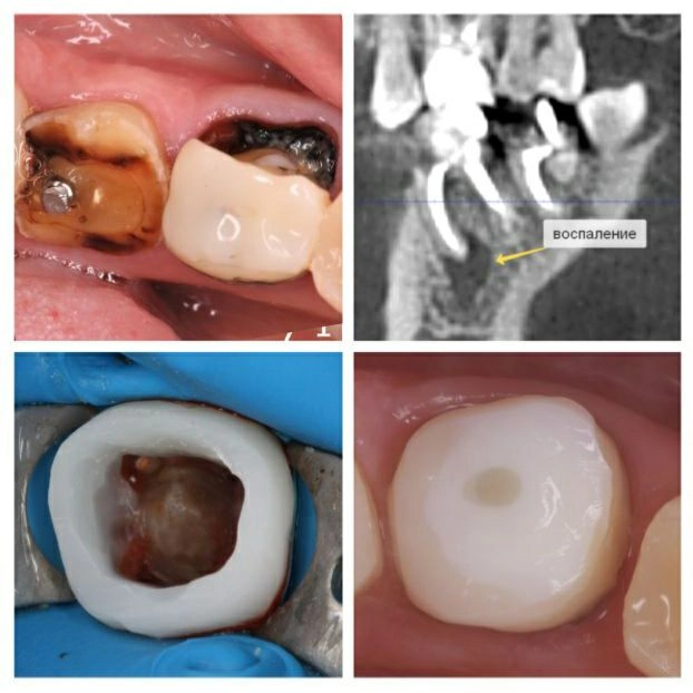 Перелечивание зубов перед лечением на брекет-системе 