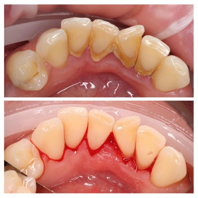 Профессиональная гигиена полости рта.