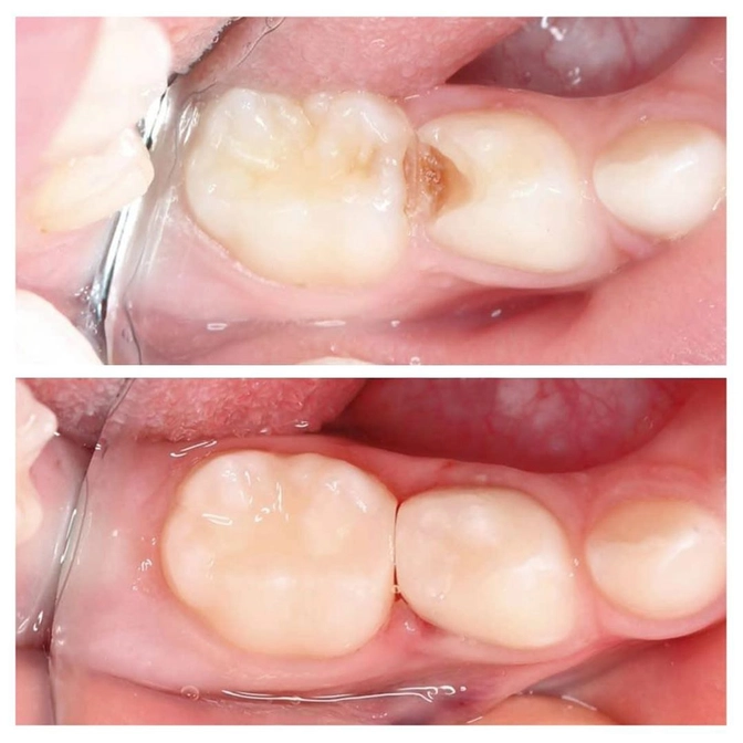 Самый коварный вид кариеса. 