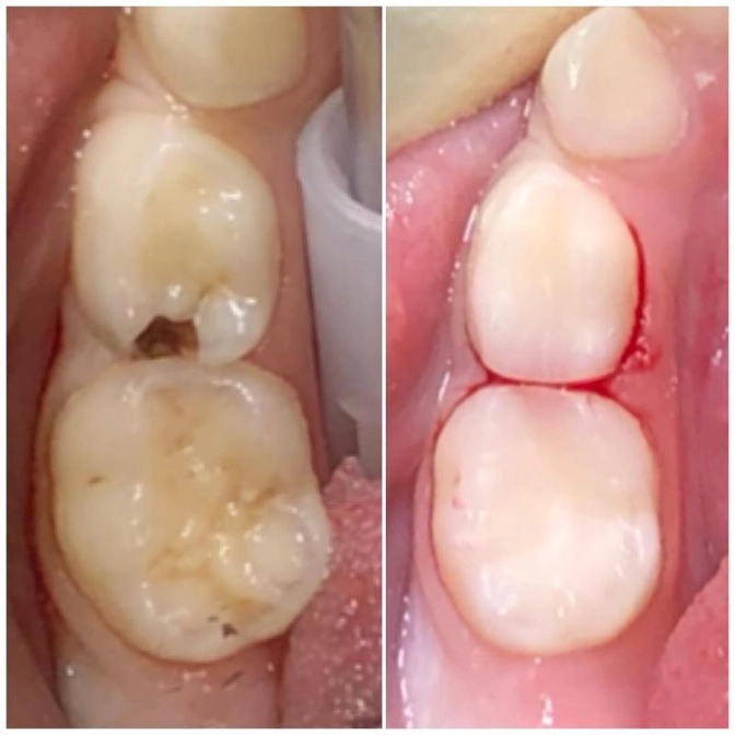 Кариес на "контактной поверхности".