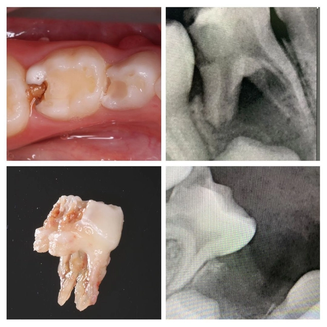 Свищ у молочного зуба - показание к удалению.