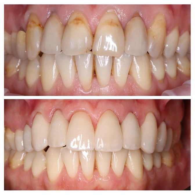 Преображение улыбки нашего пациента.