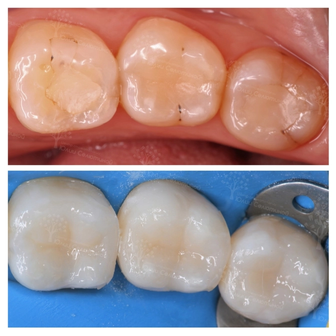 Как развивается вторичный кариес? 