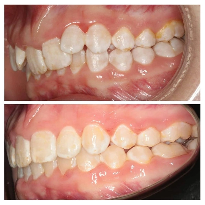 Исправление прикуса: результат за год. 