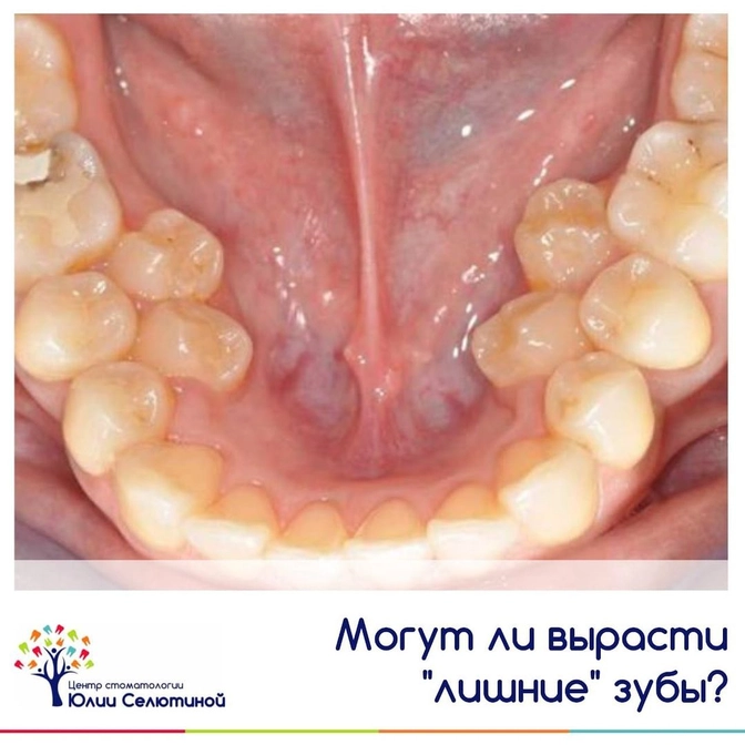 Сверхкомплектный зуб - что это?