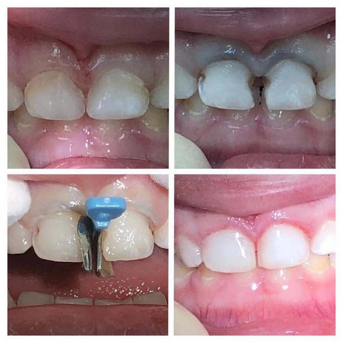 Ждать или лечить под наркозом? 