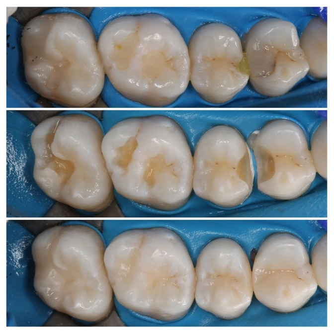 Лечение нескольких зубов за одно посещение 
