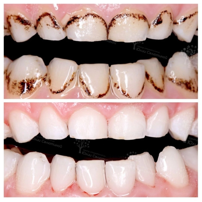 Налёт Пристли: в чем опасность?