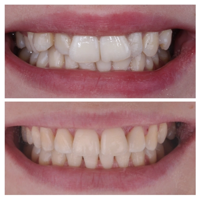 Исправление прикуса и эстетики: клинический случай нашей пациентки