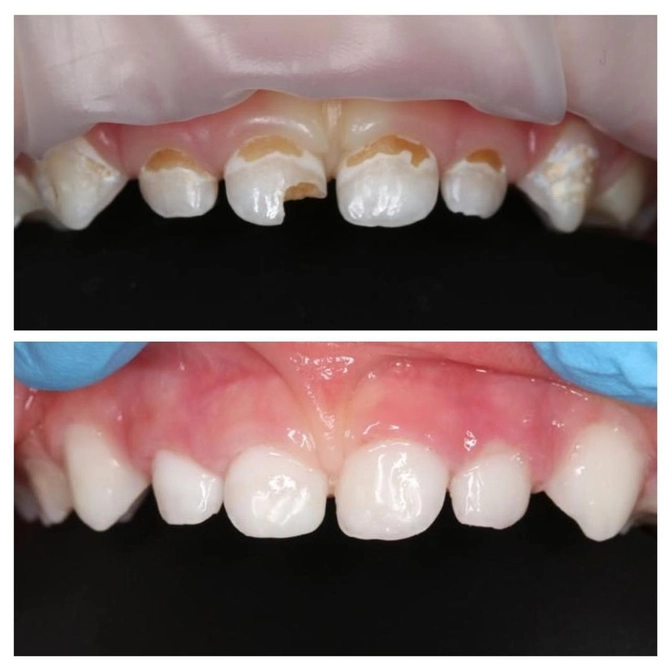 Информация для родителей, боящихся лечения зубов под наркозом...