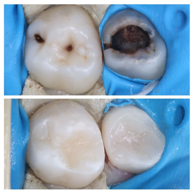 Лечение молочных зубов 