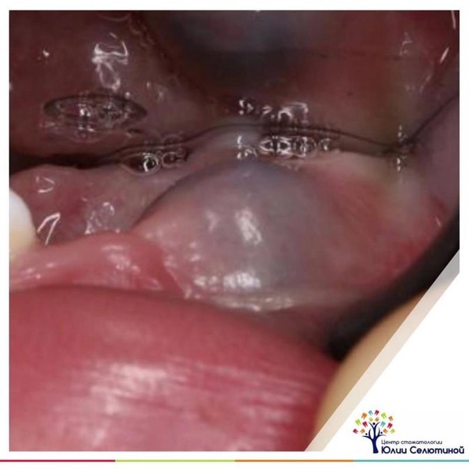 "Синяк" при прорезывании