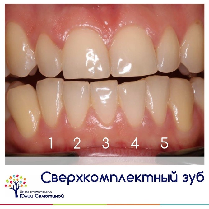 Сверхкомплектные зубы 