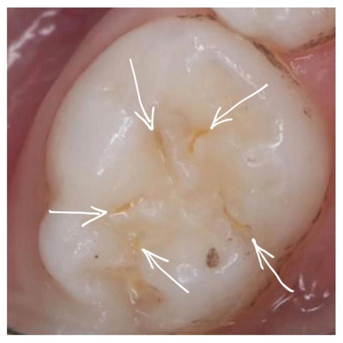 Кариес в начальной стадии - как распознать?