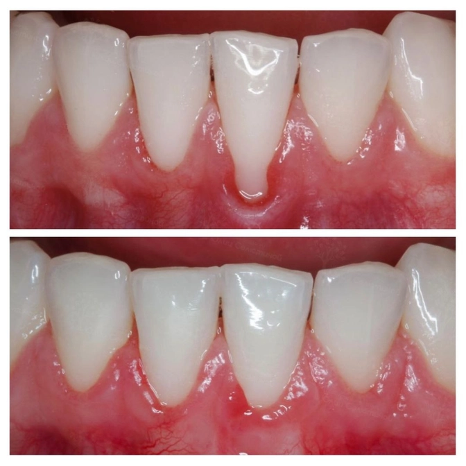 Хирургическое лечение рецессии десны