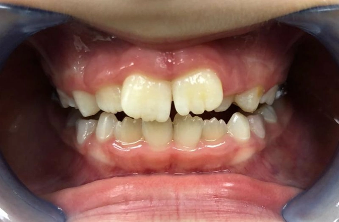 Ортодонтический аппарат Haas.