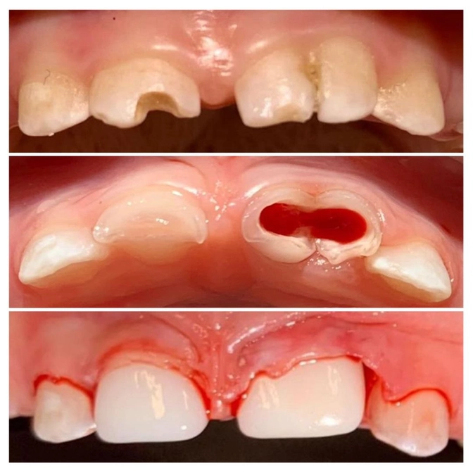 Синодентия у малыша и лечение под наркозом 