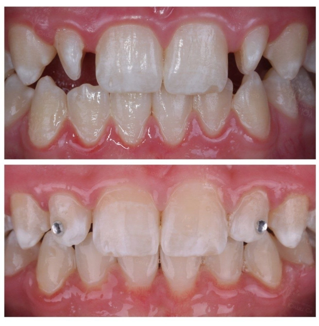 Преображение улыбки после ношения брекетов