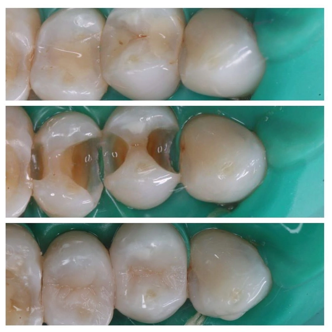 Что происходит под старой пломбой...