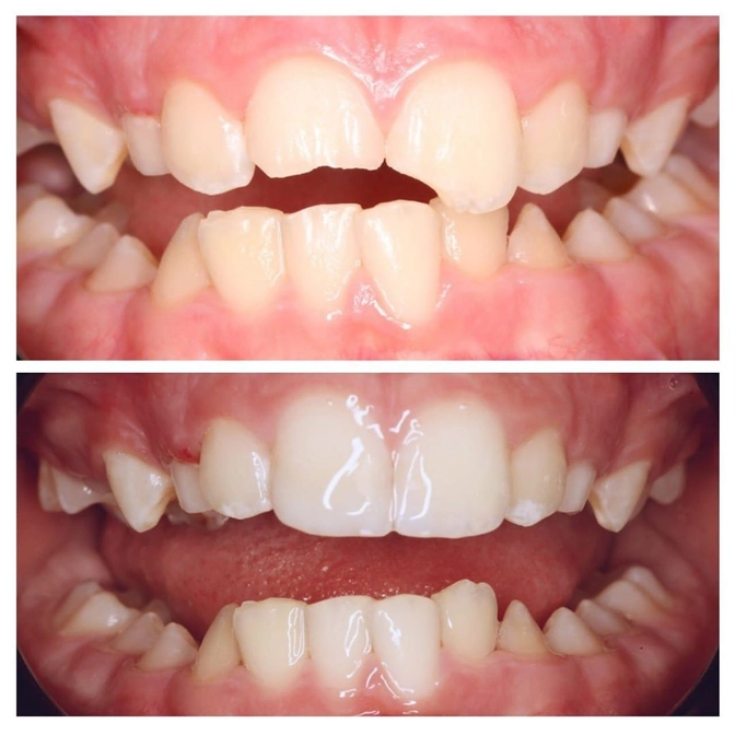 Реставрация центрального постоянного зуба у ребёнка.