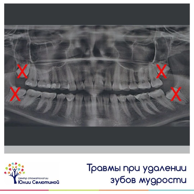 Травмы и осложнения при удалении зуба мудрости 