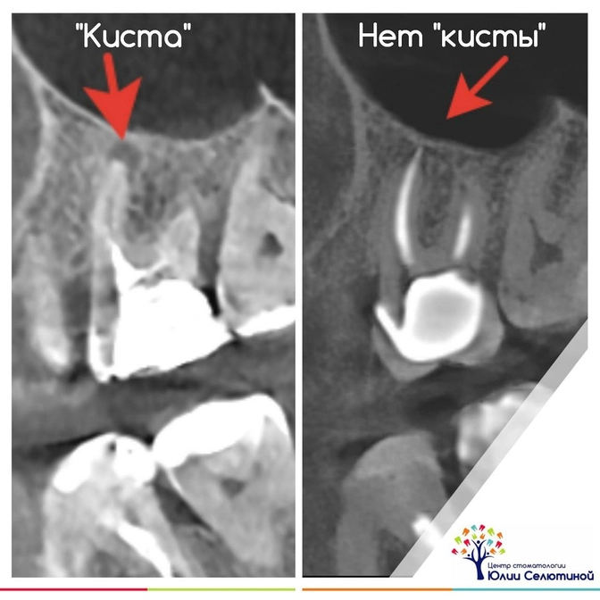 "Киста": терапевтическое лечение 