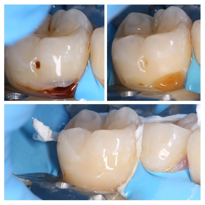 Лечение пришеечного кариеса
