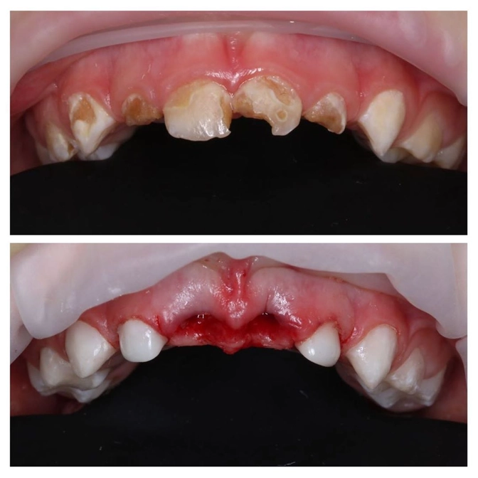 Лечение молочных зубов под наркозом 