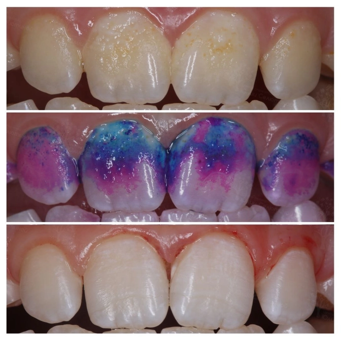 Использование индикатора зубного налета в практике врача