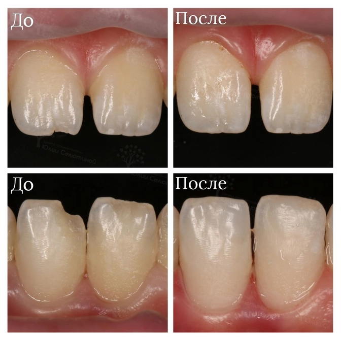 Что делать,если произошёл скол зуба?